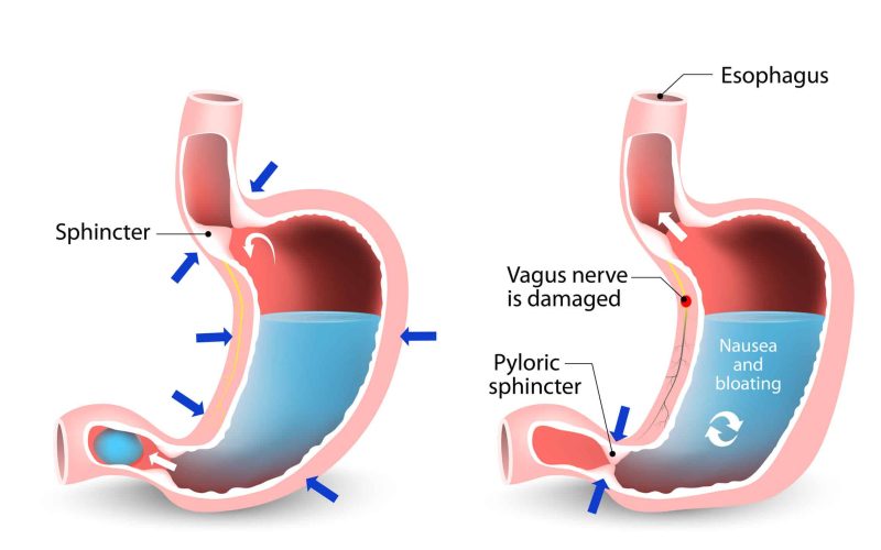 Gastroparesis or delayed gastric emptying. Visual comparison of healthy gastric and stomach with Gastroparesis.